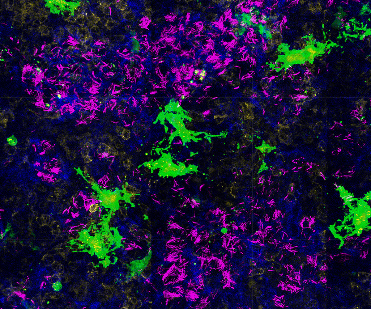 Green, blue, black, and magenta shapes indicate biological markers. Magenta (indicating tuberculosis) covers a lot of the image.